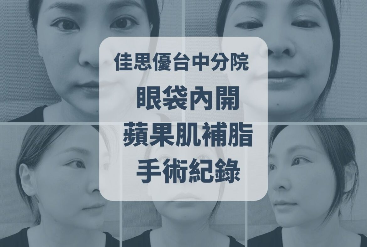 佳思優眼袋首頁圖